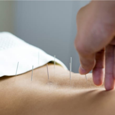 Acupuncture Consultation and Treatment Image